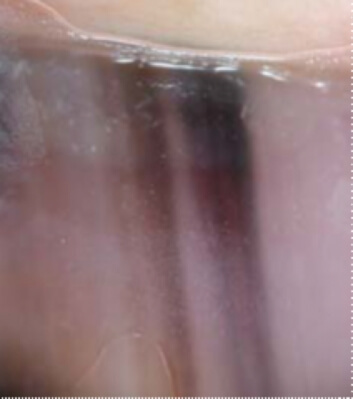 Mélanome de l'ongle débutant